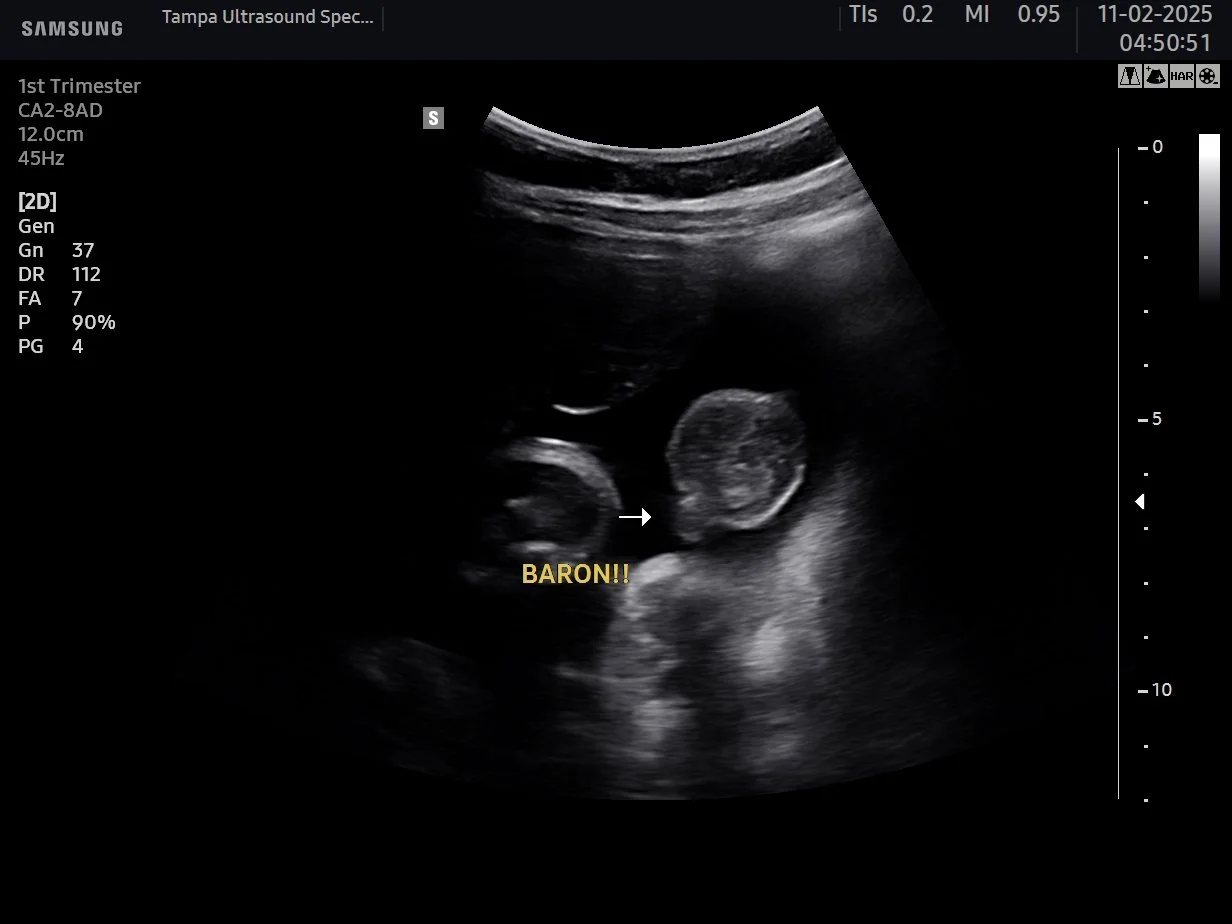 3D ultrasound for early gender determination at 14–16 weeks