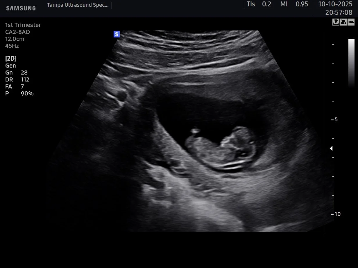 Pregnancy confimation 2d ultrasound tampa