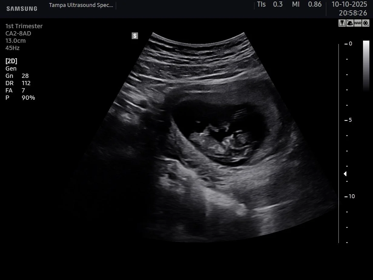 pregnancy confirmation ultrasound showing early gestational sac