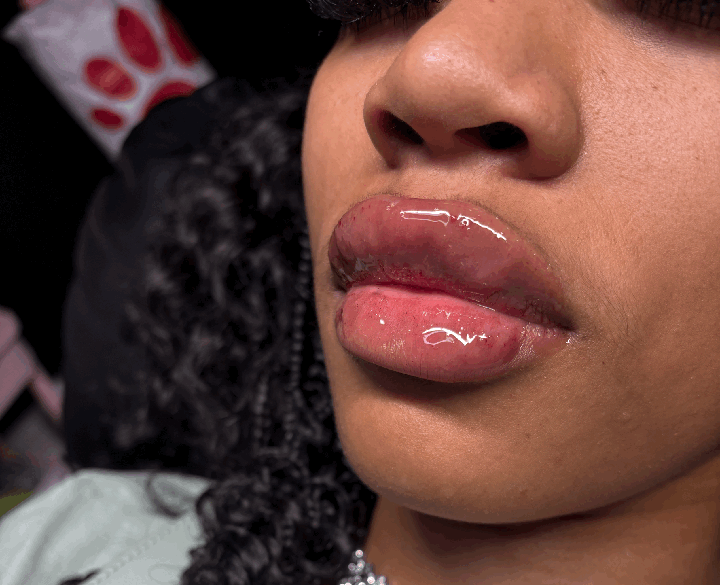 Lip Fillers