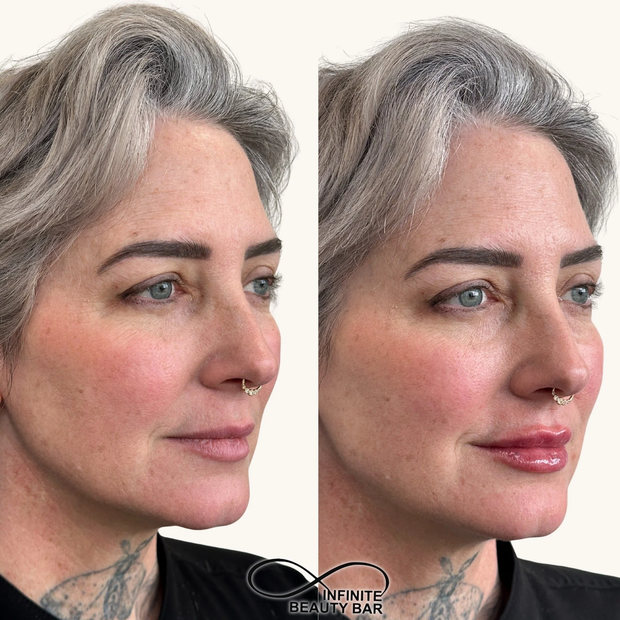 The Valentine&rsquo;s love doesn&rsquo;t stop here 💌

Keep the glow going with soft, natural-looking lip enhancement &mdash; the perfect little treat for yourself after all the chocolates and flowers 💋✨

Subtle, balanced, and beautifully you.
Call 