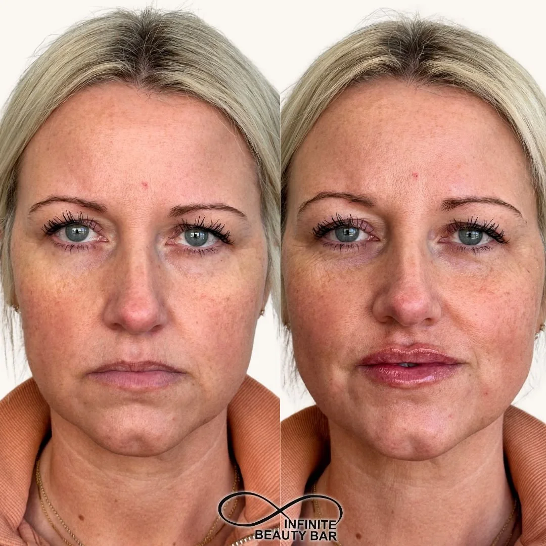 Subtle, natural, and refreshed ✨
A little enhancement can go a long way! Take this as your sign to book your lip filler appointment TODAY!💋✨

📍Infinite Beauty Bar- Kearney, MO
📱(816) 761-3230
🔗www.infinitebeautybar.biz