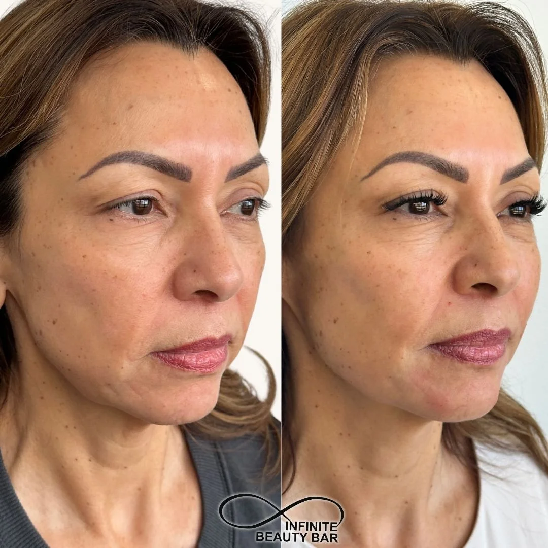 Sculpted, lifted, and still so natural 🤍

Strategic filler in the cheeks and jawline with softening around the mouth for a more lifted, refreshed look ✨ No heaviness, no overfilling&mdash;just subtle balance and definition 💉

📍Infinite Beauty Bar-