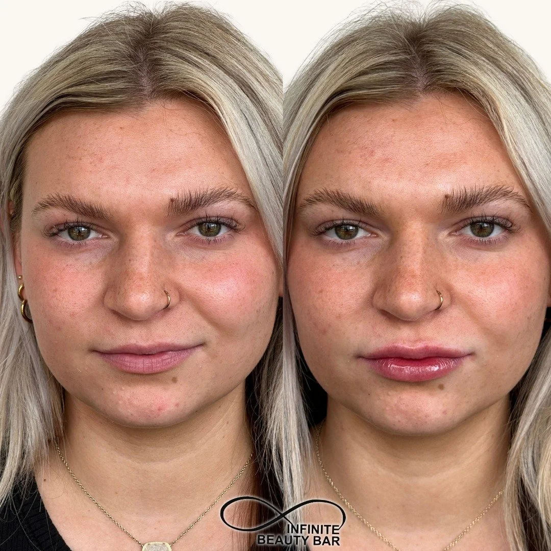 A subtle pout, balanced shape, and the prettiest hydration 💋
Lip filler can enhance your natural lips without looking overdone &mdash; just smooth, soft, and refreshed. ✨

Ready for your own lip glow-up?

📍 Infinite Beauty Bar 
📞 (816) 761-3230 te