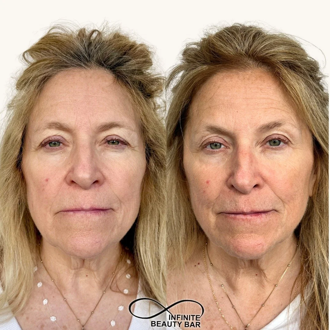 ✨ A subtle lift can make a big difference. ✨

This tox brow lift helps create a more refreshed, open-eyed appearance by relaxing the muscles that pull the brows downward, allowing the natural arch to shine. No surgery, just strategic placement and be
