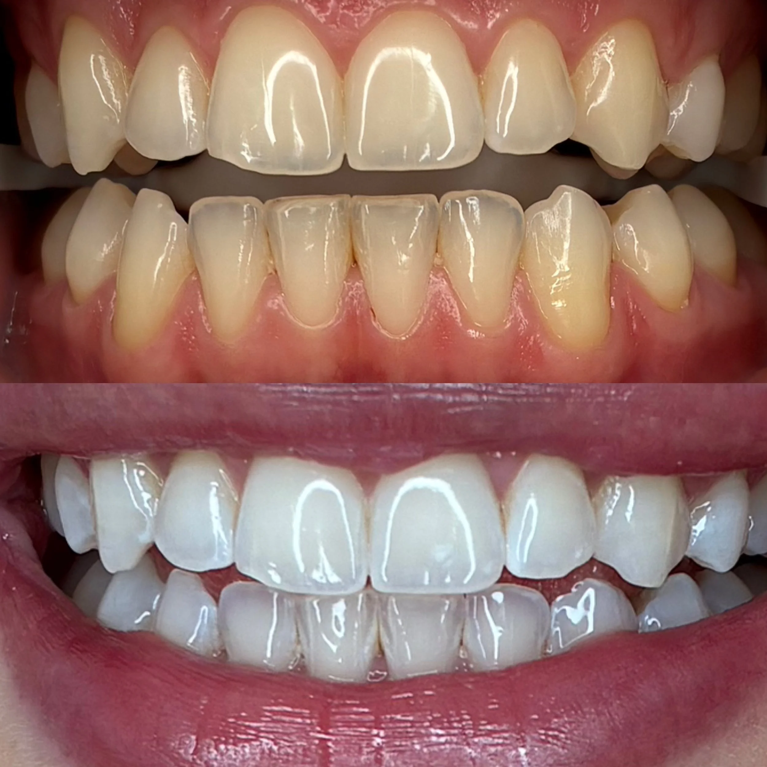 teeth whitening results, before and after