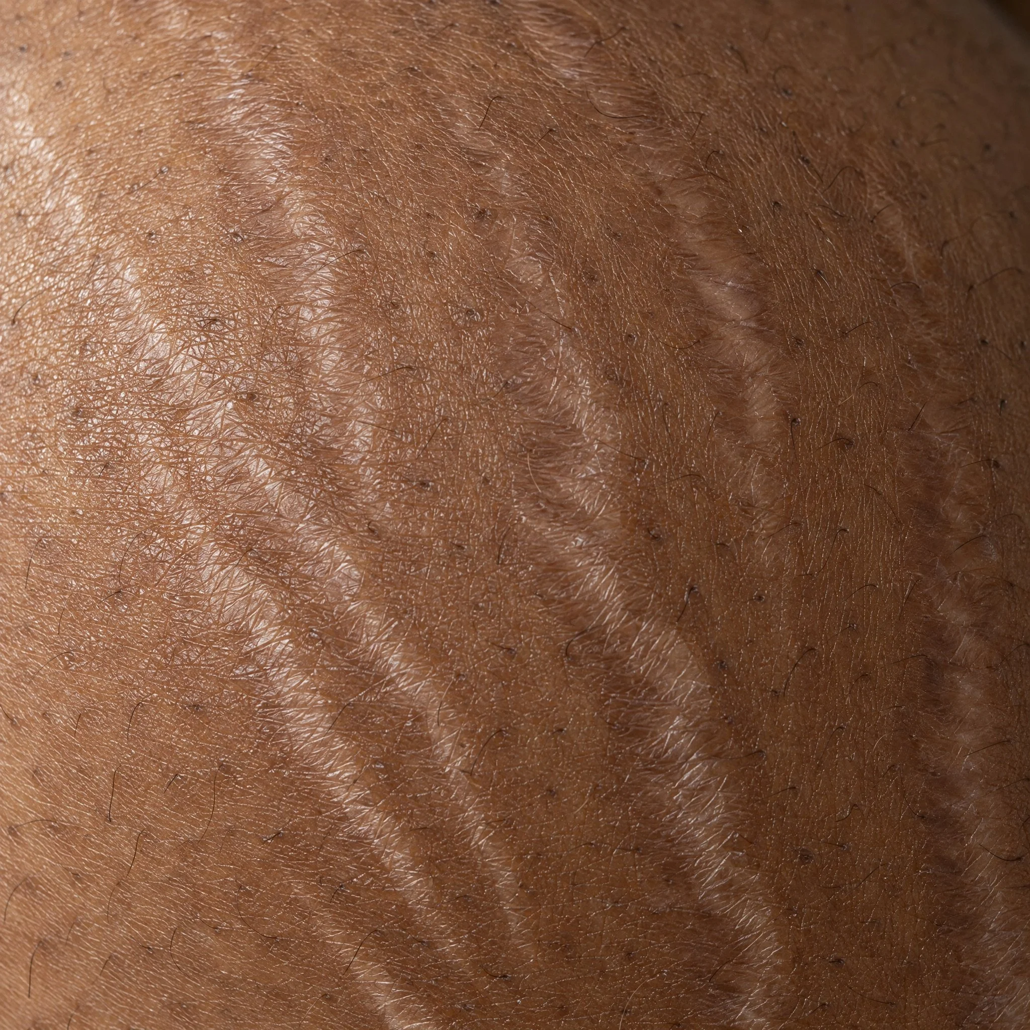 20b_surface_stretch-marks.jpeg