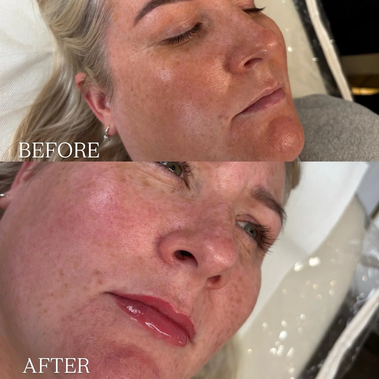 This is how lip blush can transform your face 👀👄

By restoring natural tone, refining the lip border and adding a soft wash of pigment, this treatment subtly transforms the whole face. Lips appear fuller, healthier and more defined - without filler