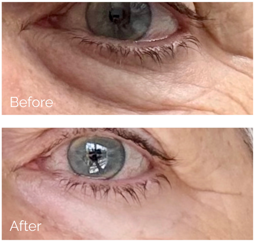 Close-up of a person's eye showing an 'before and after' comparison. The 'before' image shows an eye with sagging skin and wrinkles, while the 'after' image shows a more lifted and youthful appearance around the eye.