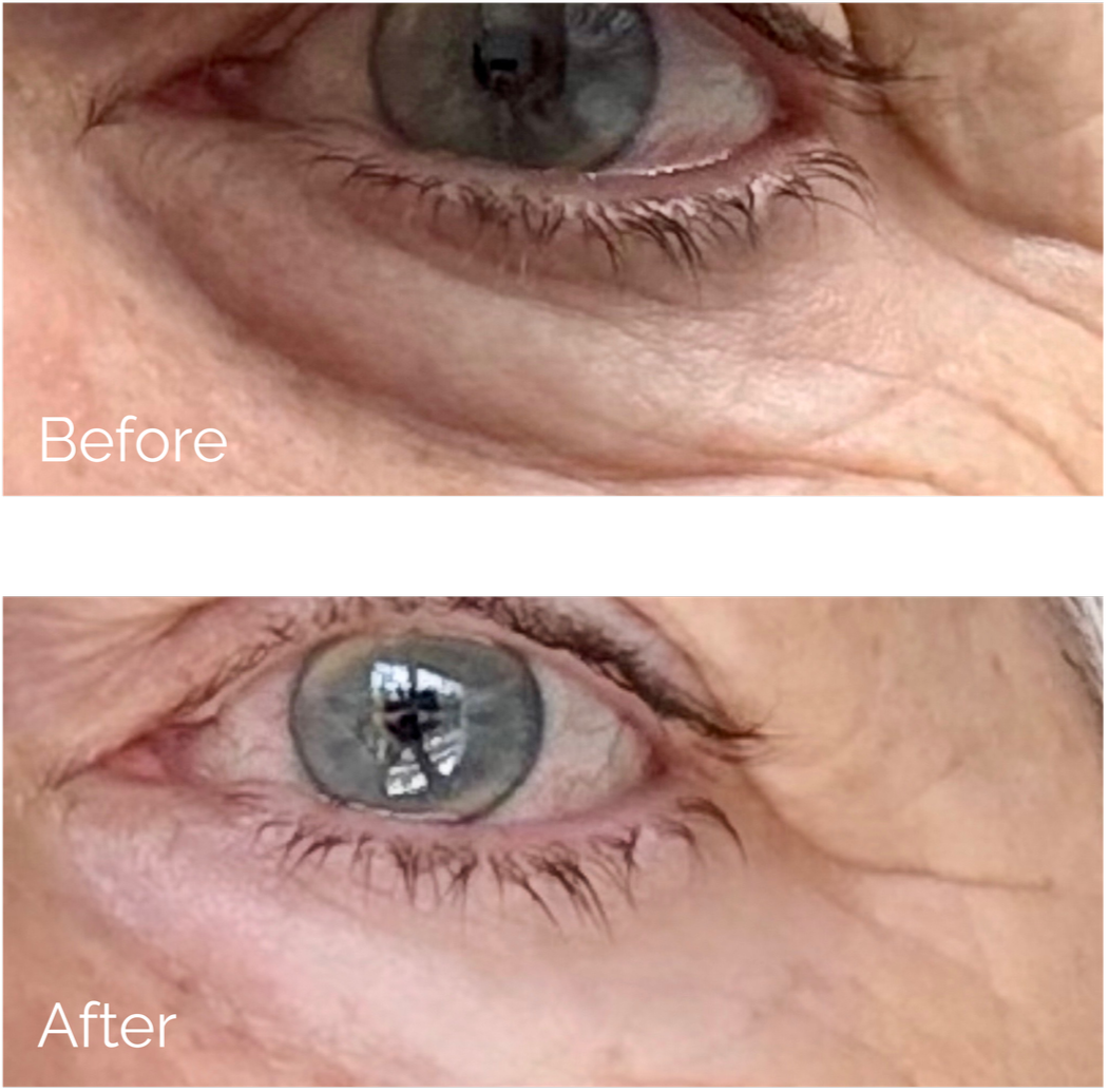 Close-up of an eye showing a comparison of the area around the eye before and after a cosmetic treatment, with improved skin appearance in the after image