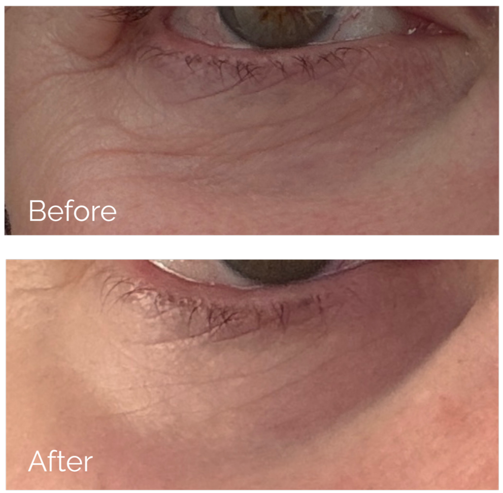 Close-up images of a person's eye showing the area just below the eye before and after a skincare treatment, with the after image displaying smoother and less wrinkled skin.