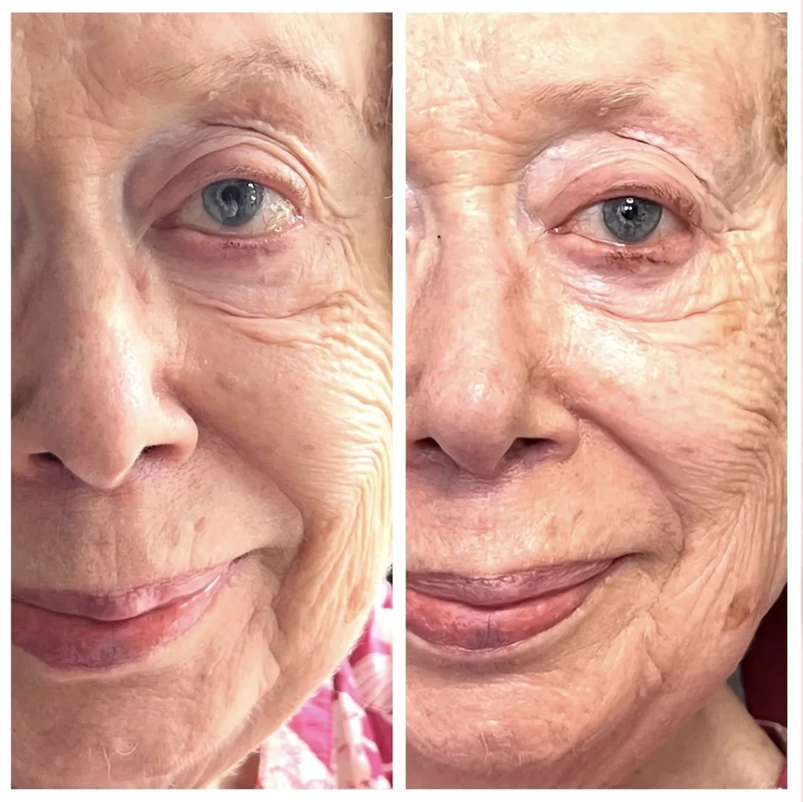Elderly skin care