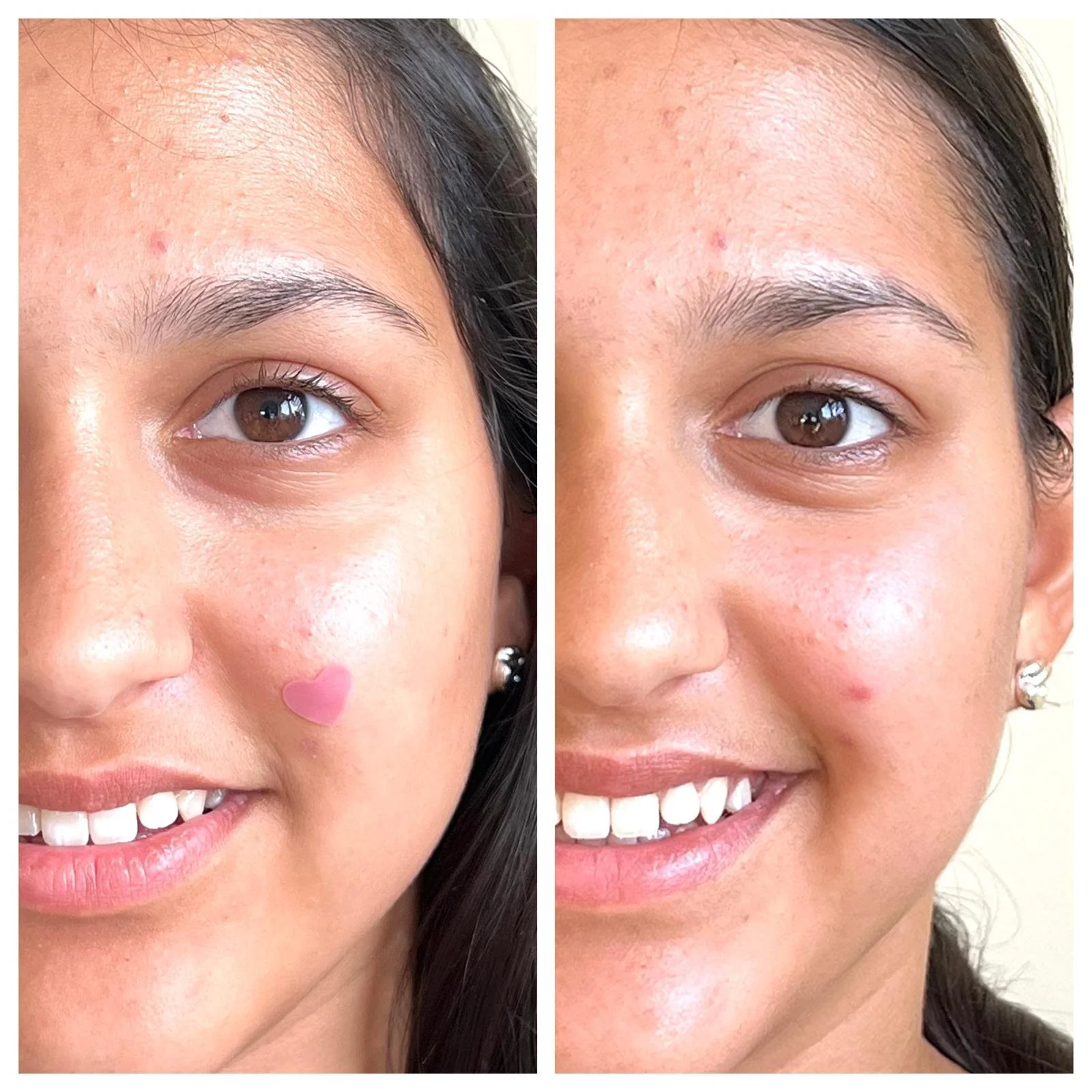 Teen skin facial London