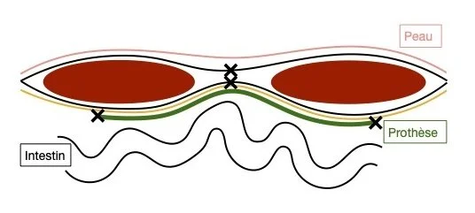 Réparation d'une hernie : prothèse fixée en arrière des muscles, entre la paroi et l'intestin