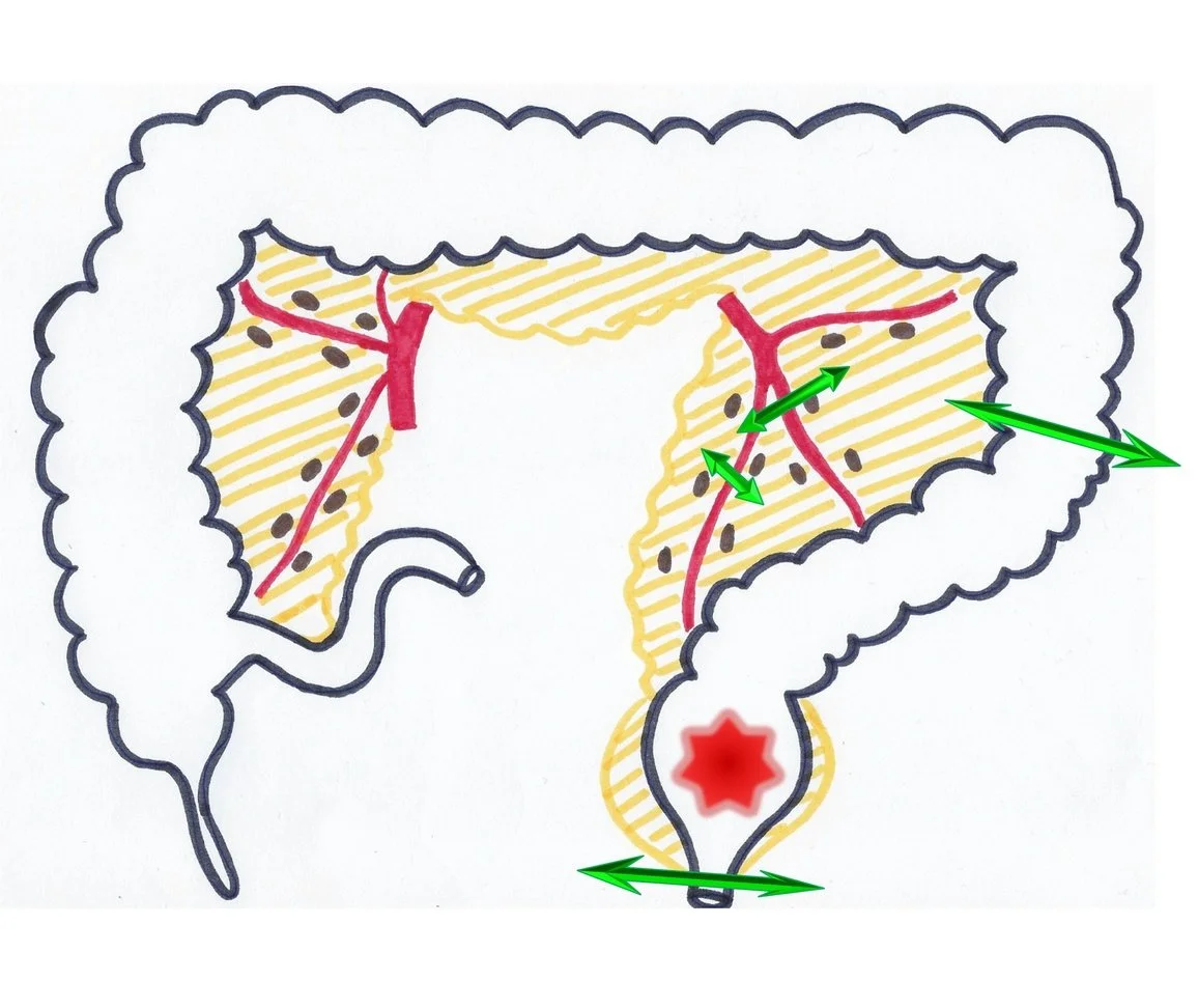 Proctectomie : limites de l'exérèse du rectum et du mésorectum, ligature vasculaire
