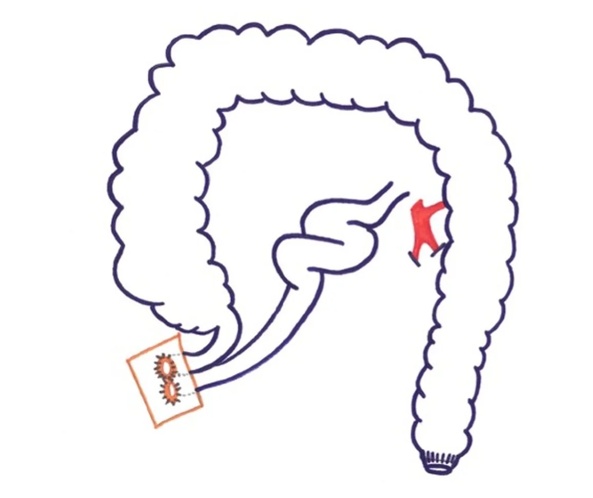 Après proctectomie : anastomose basse et iléostomie de protection temporaire