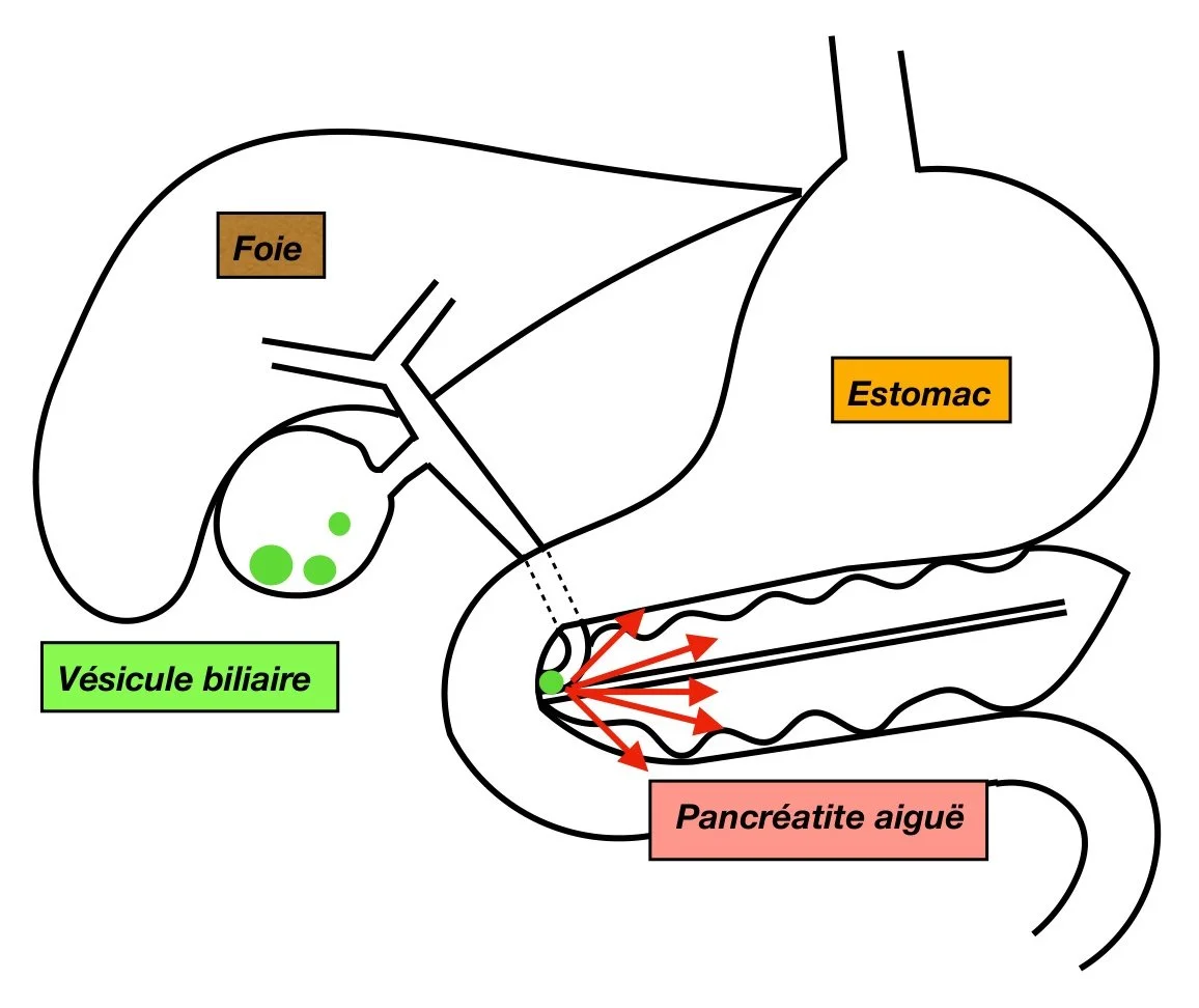 Pancréatite aiguë biliaire : calcul bloqué à la sortie du cholédoque, inflammation du pancréas