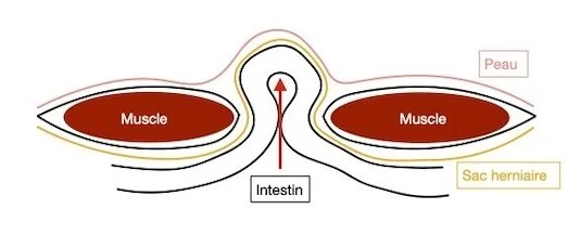 Schéma d'une hernie : l'intestin, dans le sac herniaire, passe entre les muscles et soulève la peau