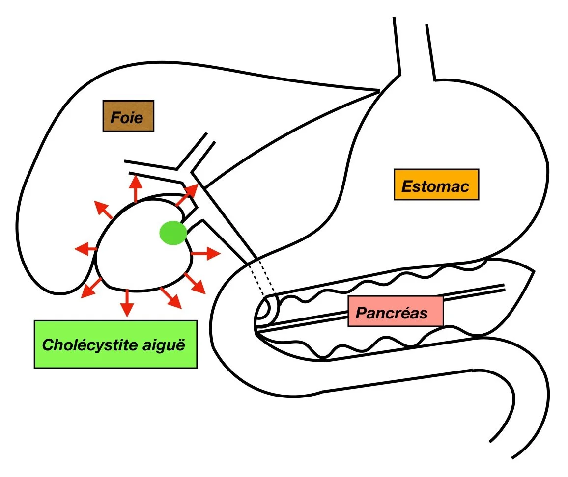 Cholécystite aiguë : calcul bloquant la sortie de la vésicule, inflammation de la vésicule
