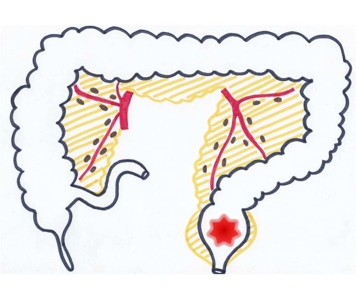 Tumeur du rectum entourée du mésorectum