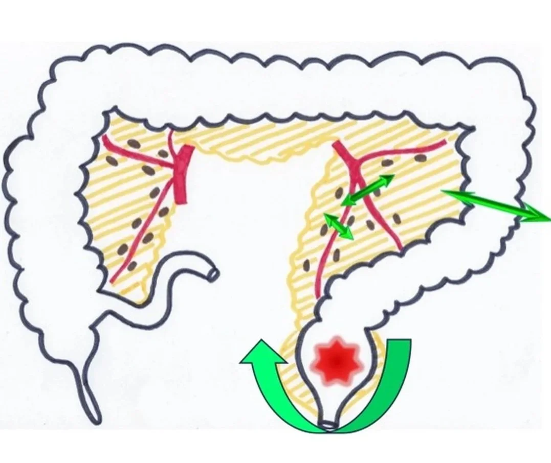 Amputation abdomino-périnéale : exérèse du rectum et de l'anus par voie abdominale et périnéale