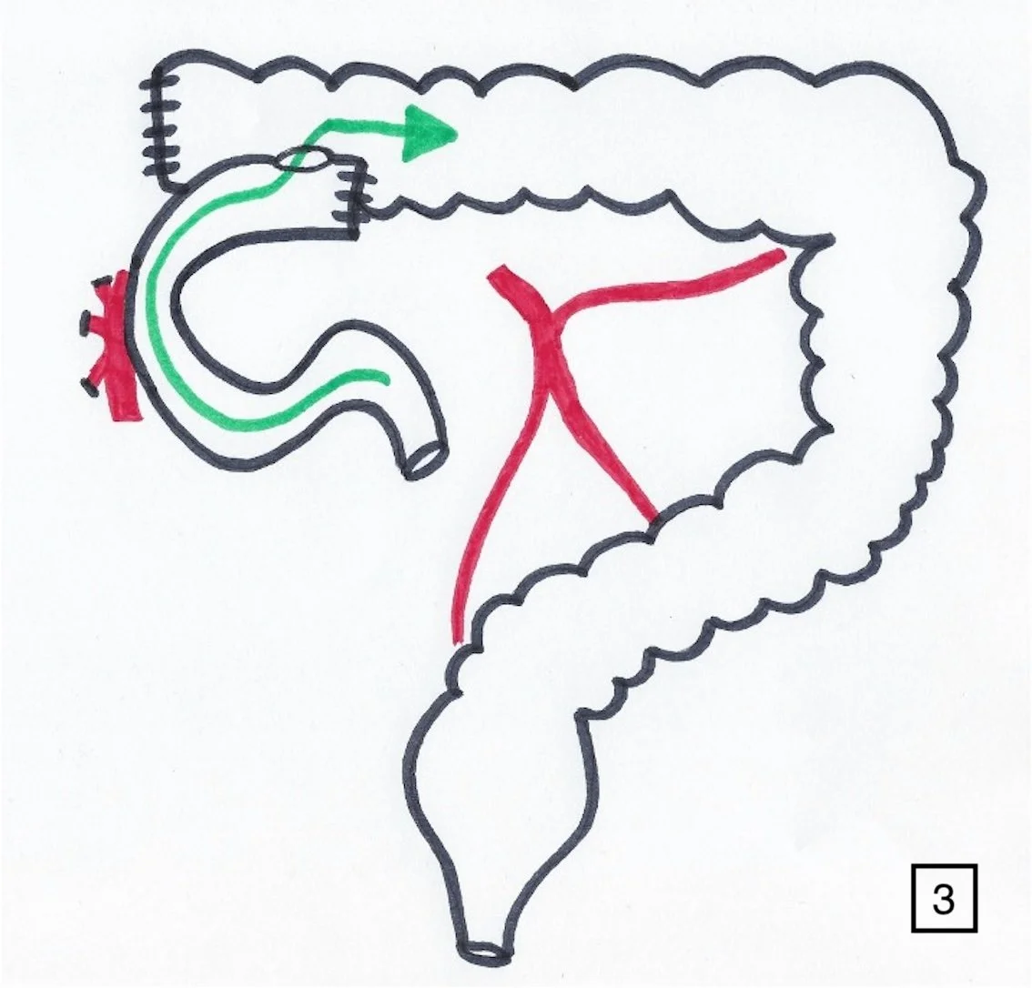 Colectomie droite, étape 3 : anastomose entre l'intestin grêle et le côlon transverse