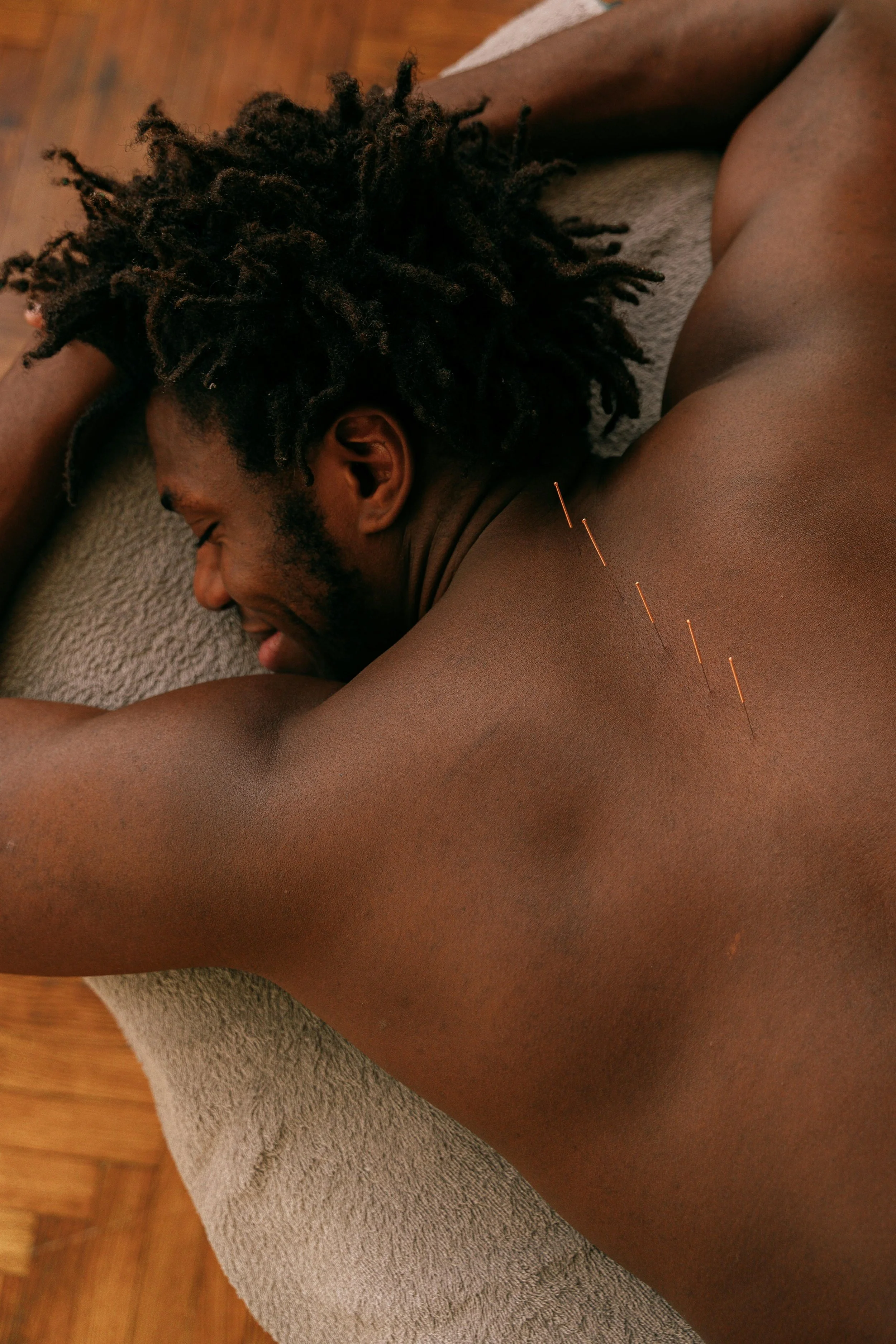 A man lying down on a massage table with acupuncture needles inserted in his back, smiling with his eyes closed.