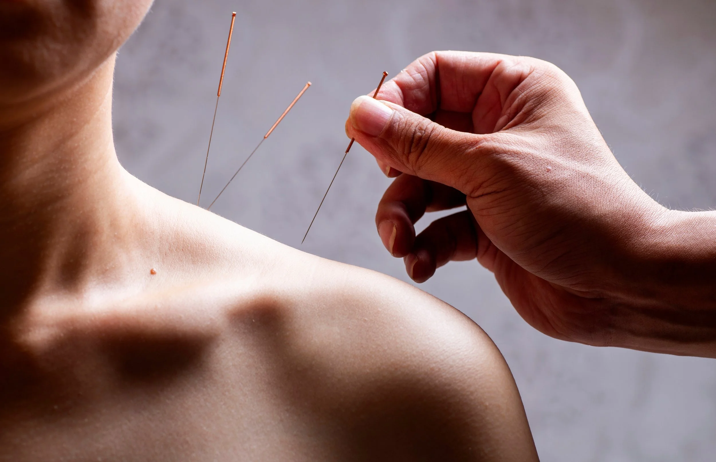 Close-up of a person receiving acupuncture, with several thin needles inserted into their shoulder and neck area.