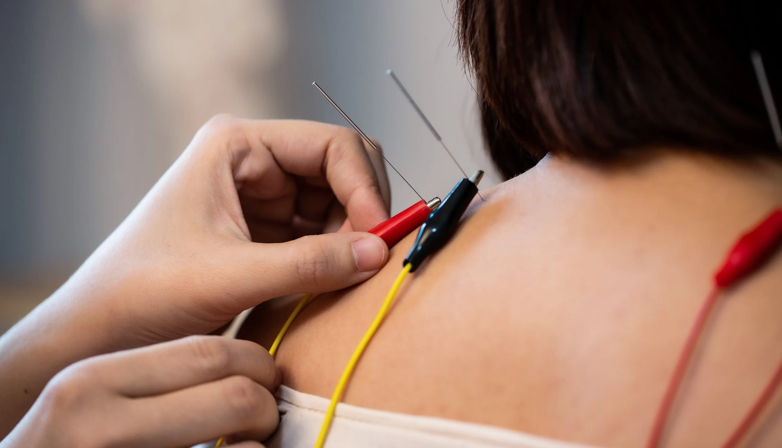 Close-up of a person receiving electroacupuncture, with thin needles inserted into their back and shoulder and colourful electrical wires attached to the needles.