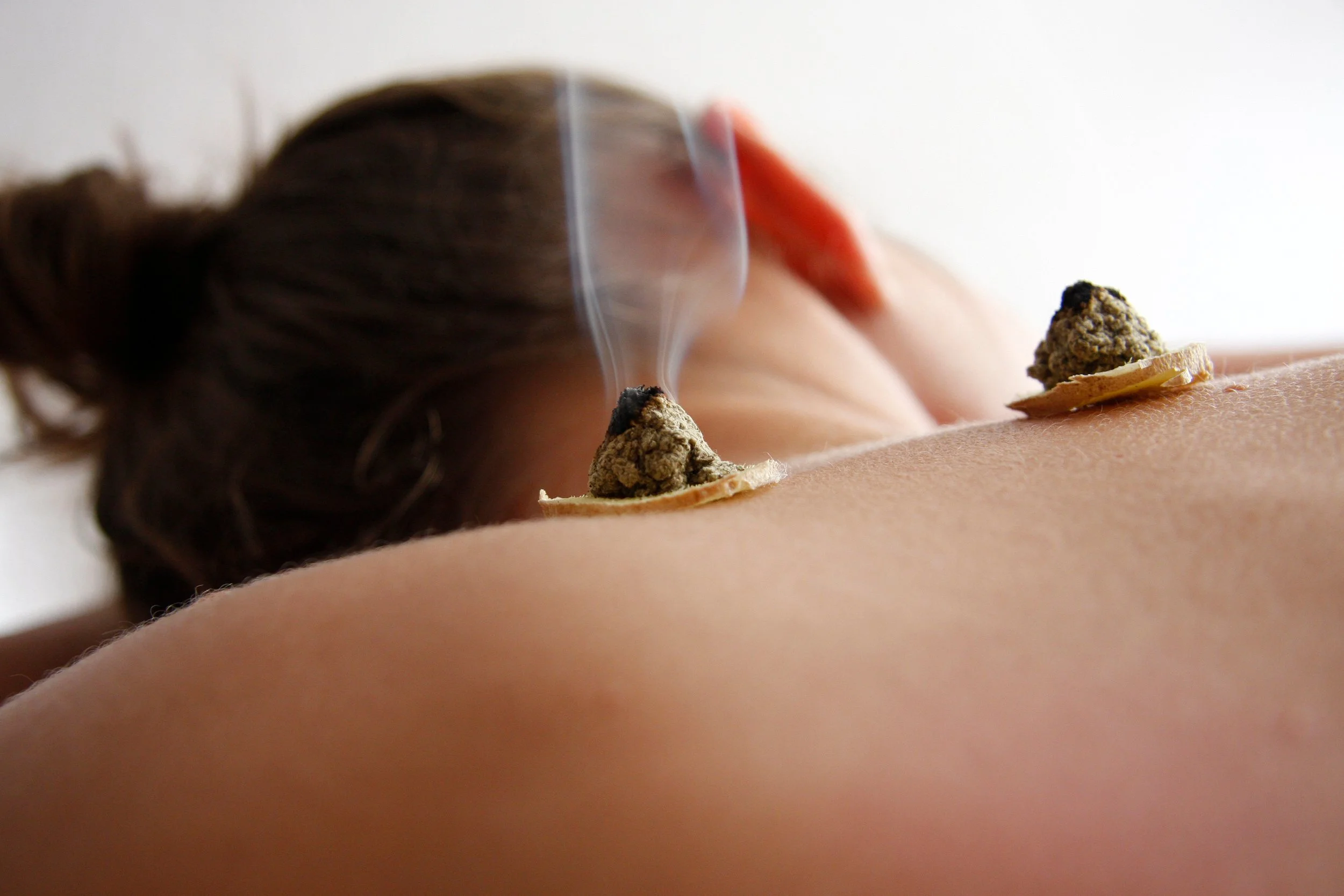 A person receiving moxibustion therapy, with moxa on ginger placed on their back and smoke rising into the air.