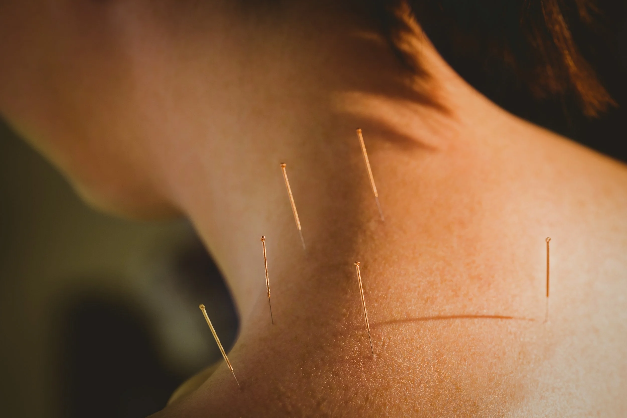 Close-up of a person receiving acupuncture with several thin needles inserted into their neck and shoulder area.