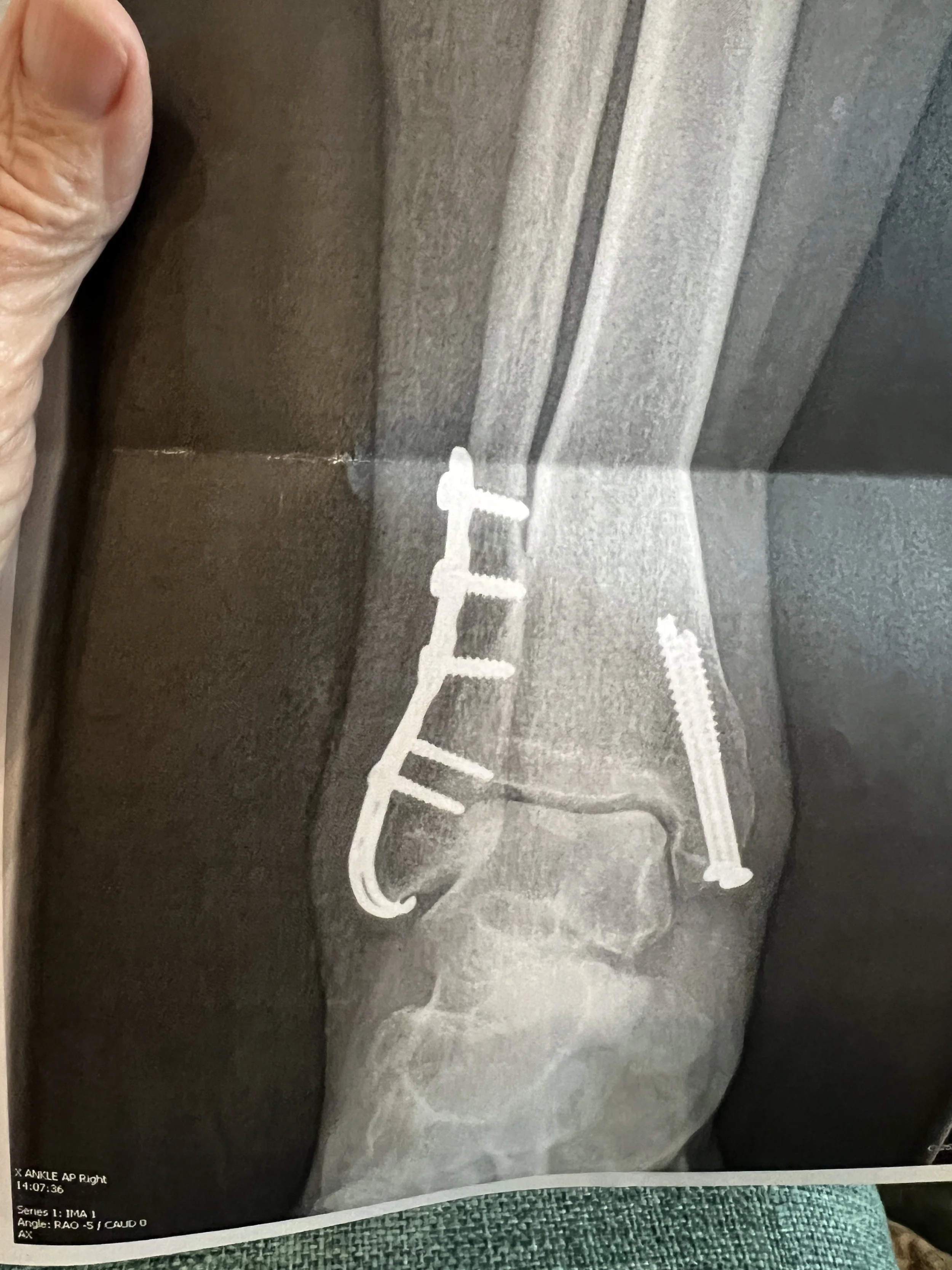 Hardware Removal After Ankle Surgery: What to Know (and What to Expect)