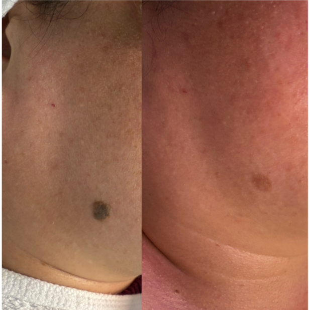 Seborrheic Keratosis Treatment