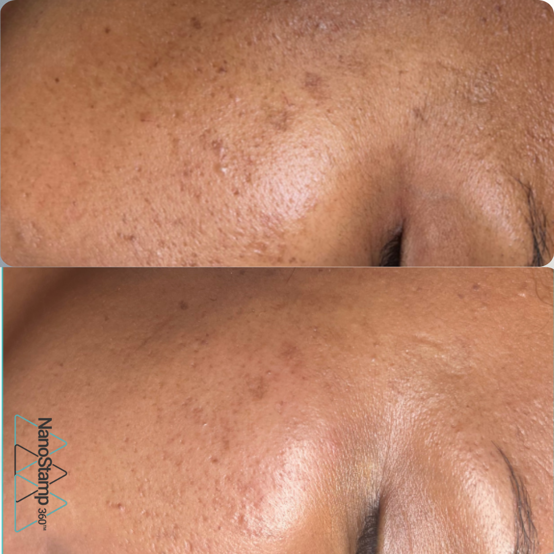 Close-up photos of skin showing improvement in skin texture and reduced pore size, before and after skincare treatment.
