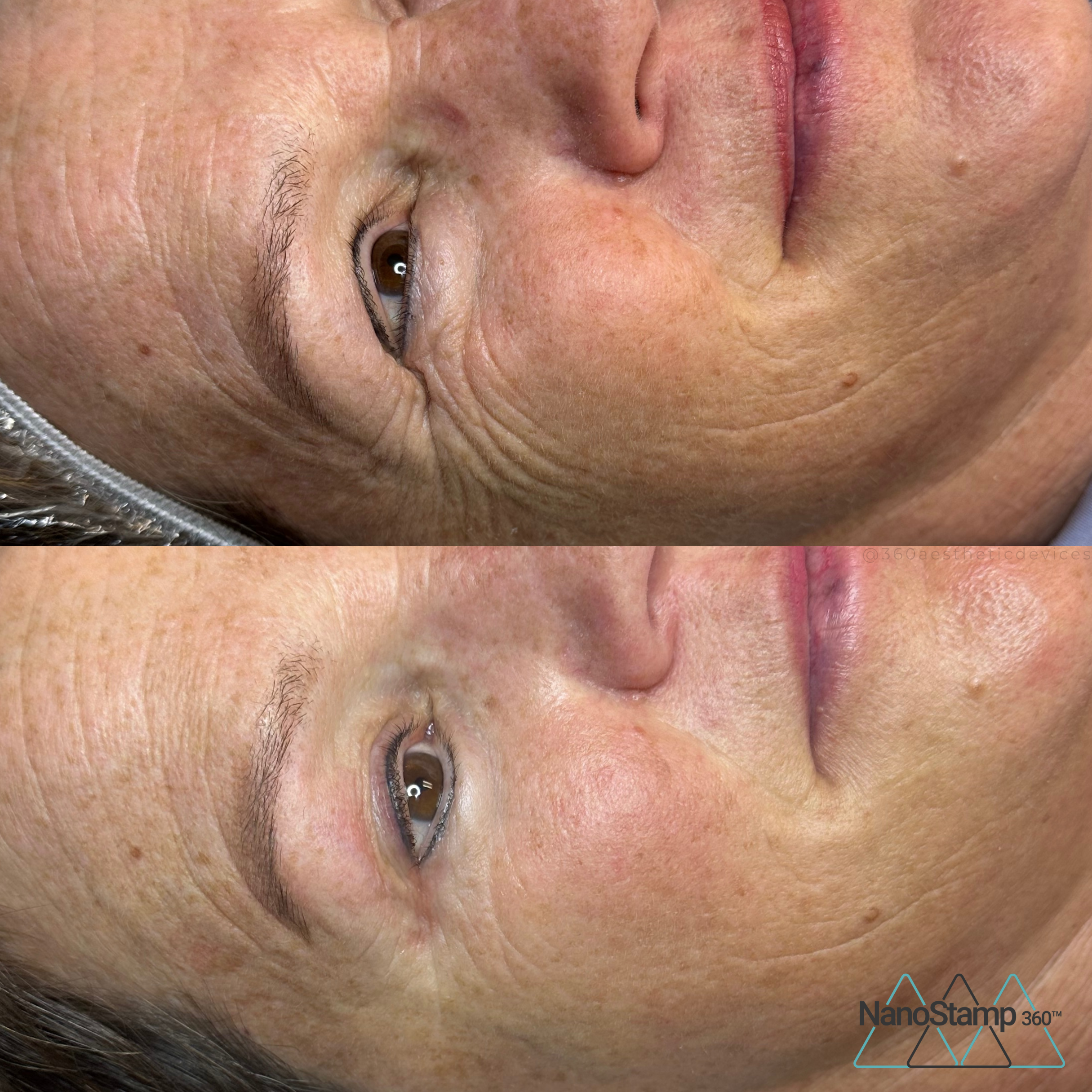 Close-up comparison of a woman's face showing the before and after effects of aesthetic treatment, highlighting smoother skin with reduced wrinkles around the eye and cheek area.