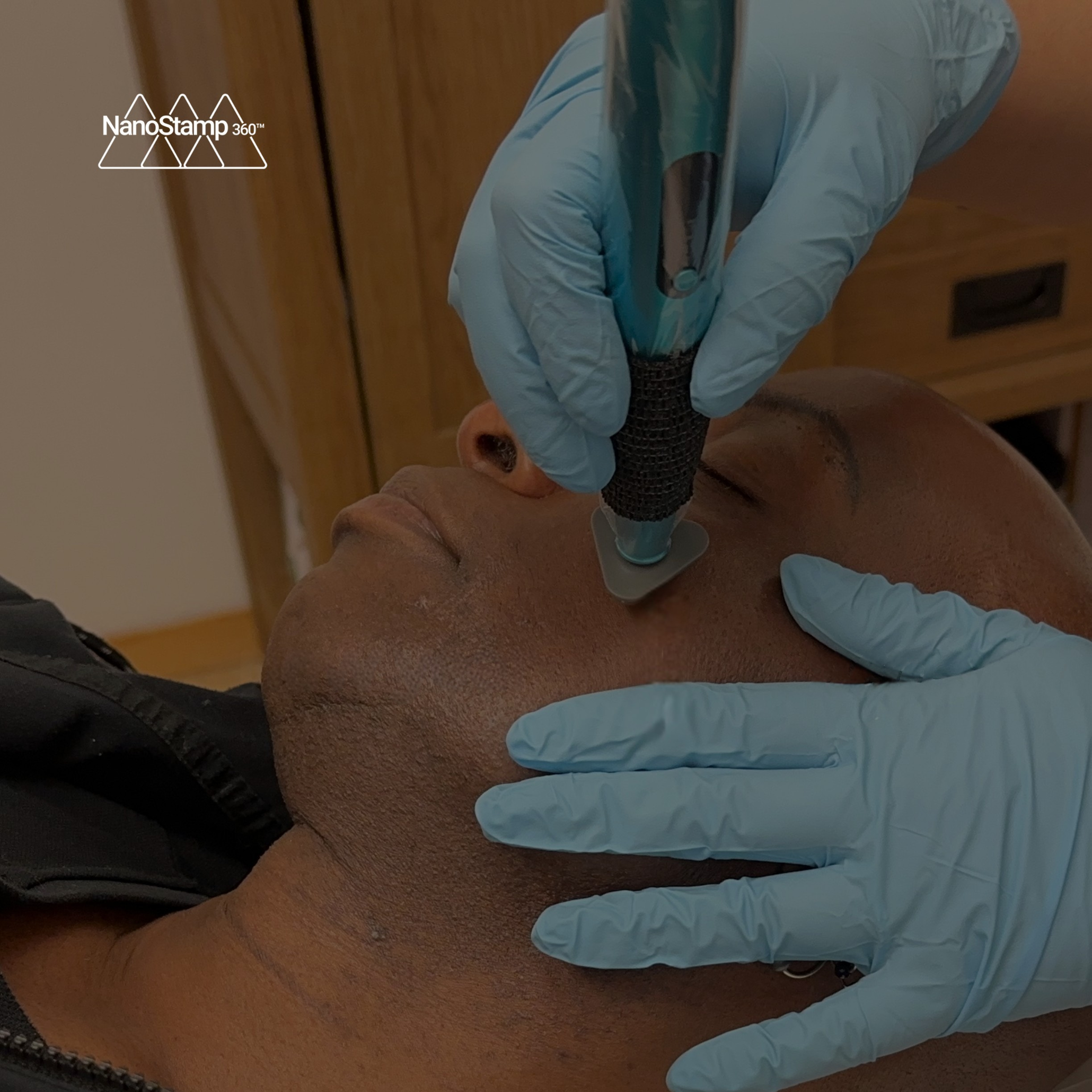 A person receiving collagen induction therapy while lying down with their eyes closed, wearing gloves for the procedure.