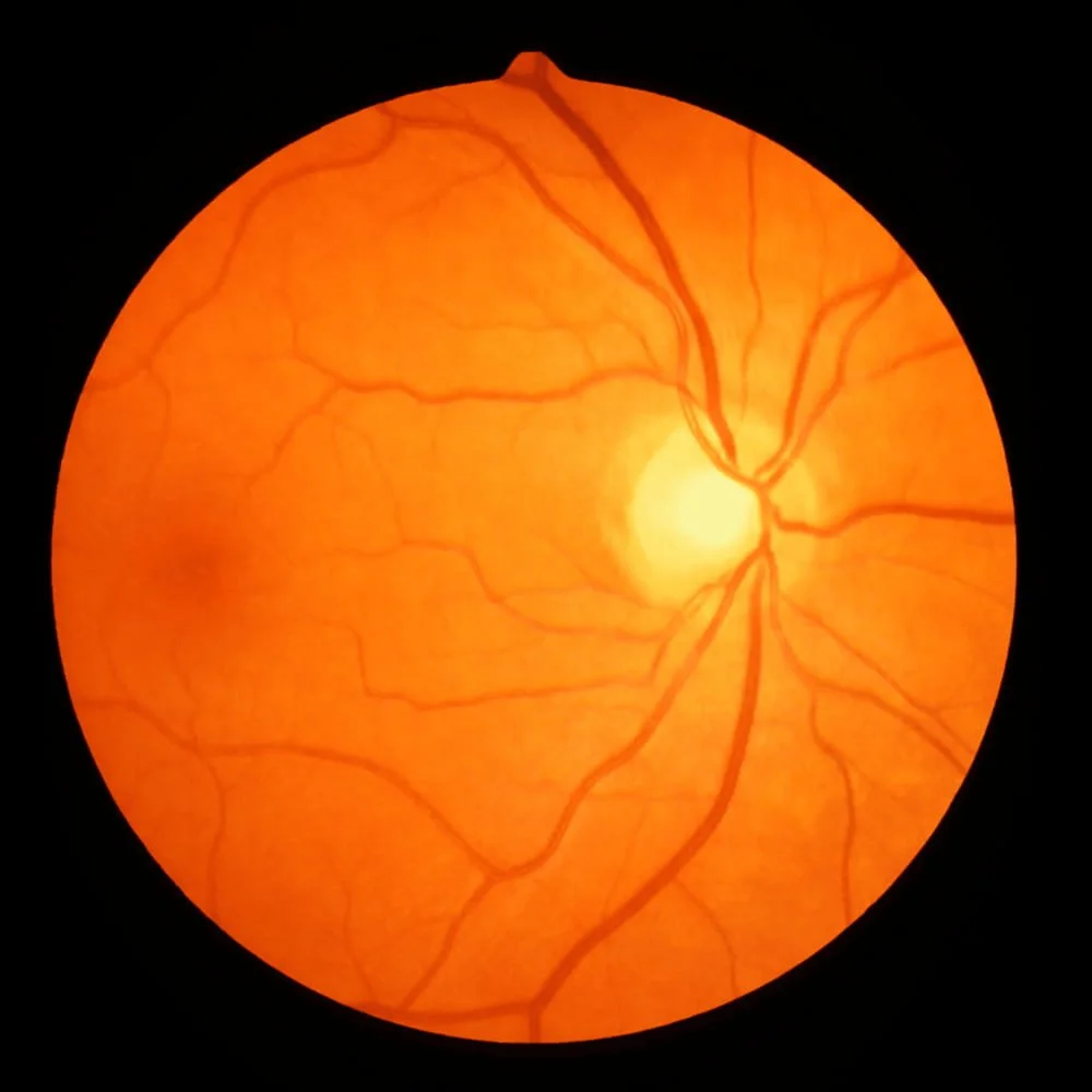 Retinal image showing the optic disc and blood vessels in the eye