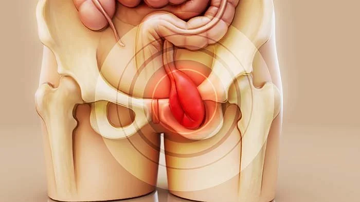 What Is the Best Treatment for an Inguinal Hernia?