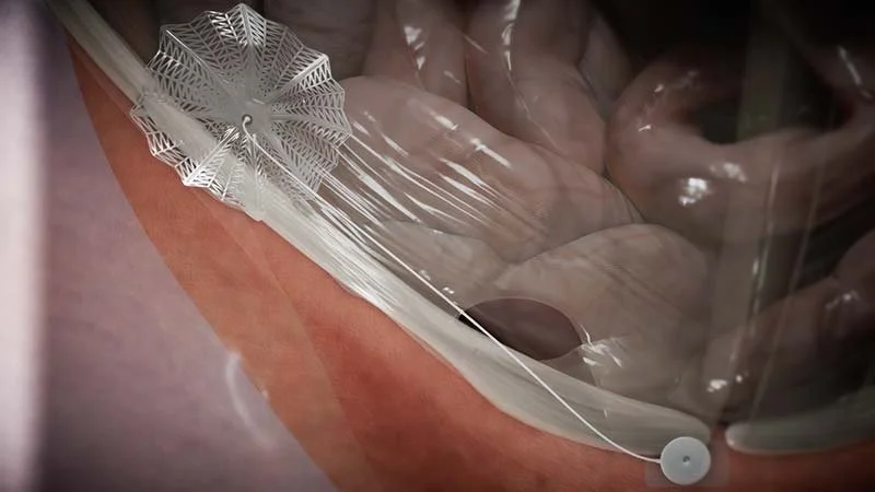 The Future of Inguinal Hernia Repair: Moving Towards Less Invasive Treatment