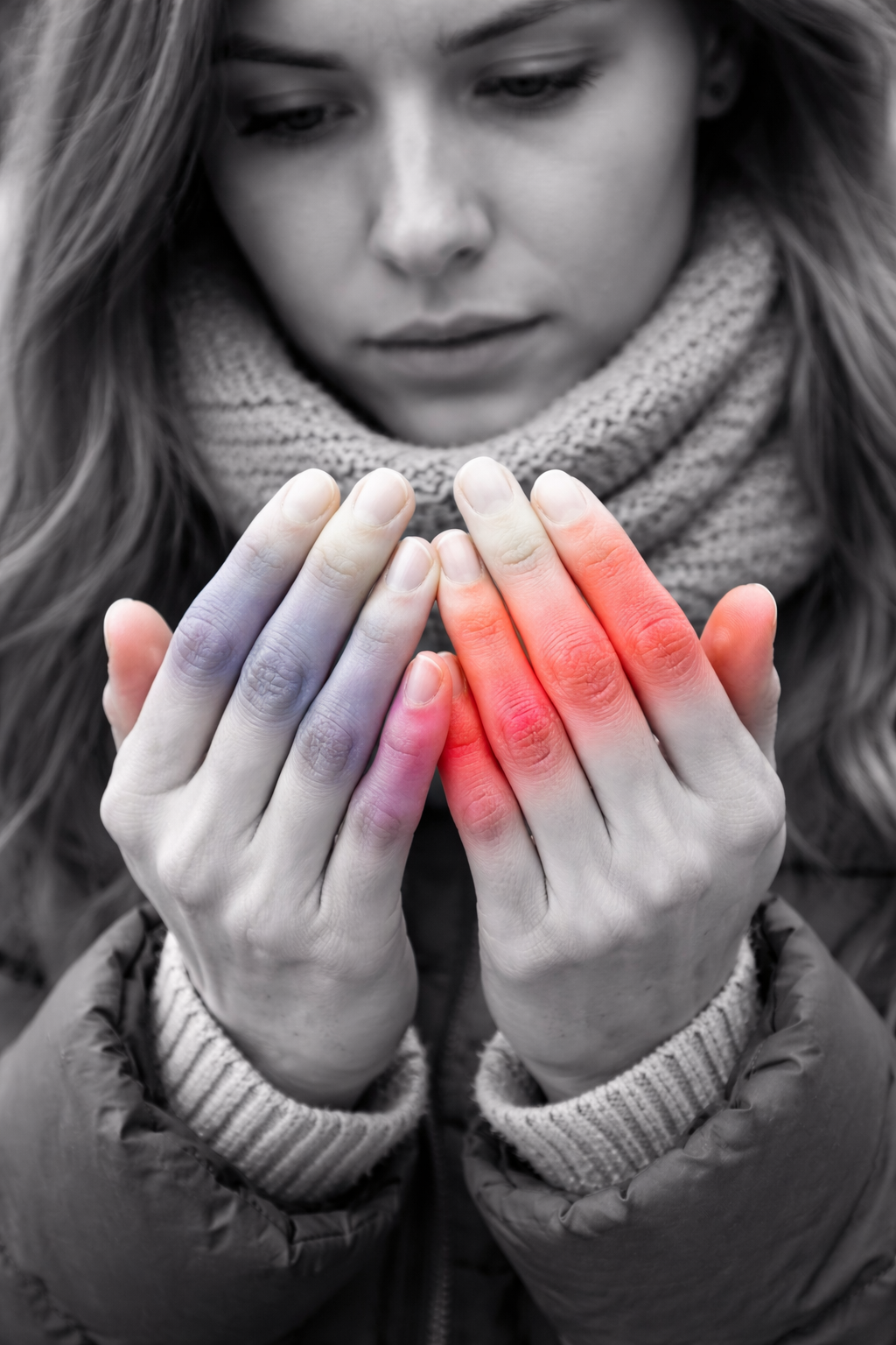 Raynaud’s and Chilblains: Understanding the Causes — and When to Look Deeper