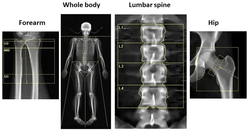 What Is a DEXA Scan — and How Is It Used in Assessing Bone Health?