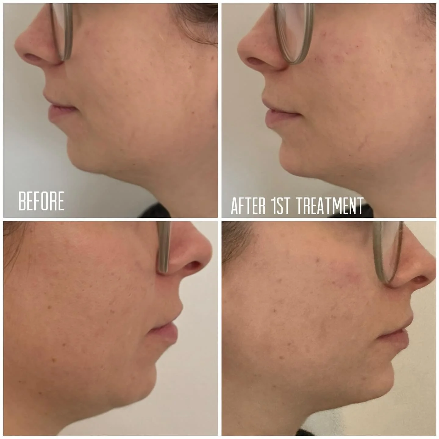 Facial harmonisation is usually a process in stages. This lovely client has had a first treatment in her chin and mid face. Final results are best done with healing in between, the filler integrates into the tissues over time. I explain the first tre