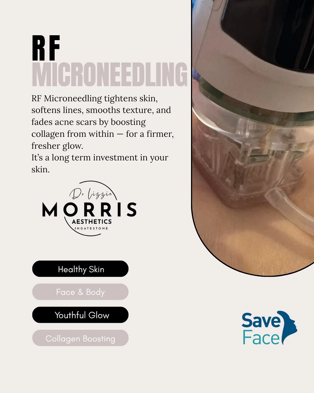 RF Microneedling = Collagen Powerhouse
This treatment creates controlled micro-injuries + radiofrequency heat to kickstart your skin&rsquo;s natural collagen production. The result? Firmer, smoother, healthier skin that improves long after the appoin