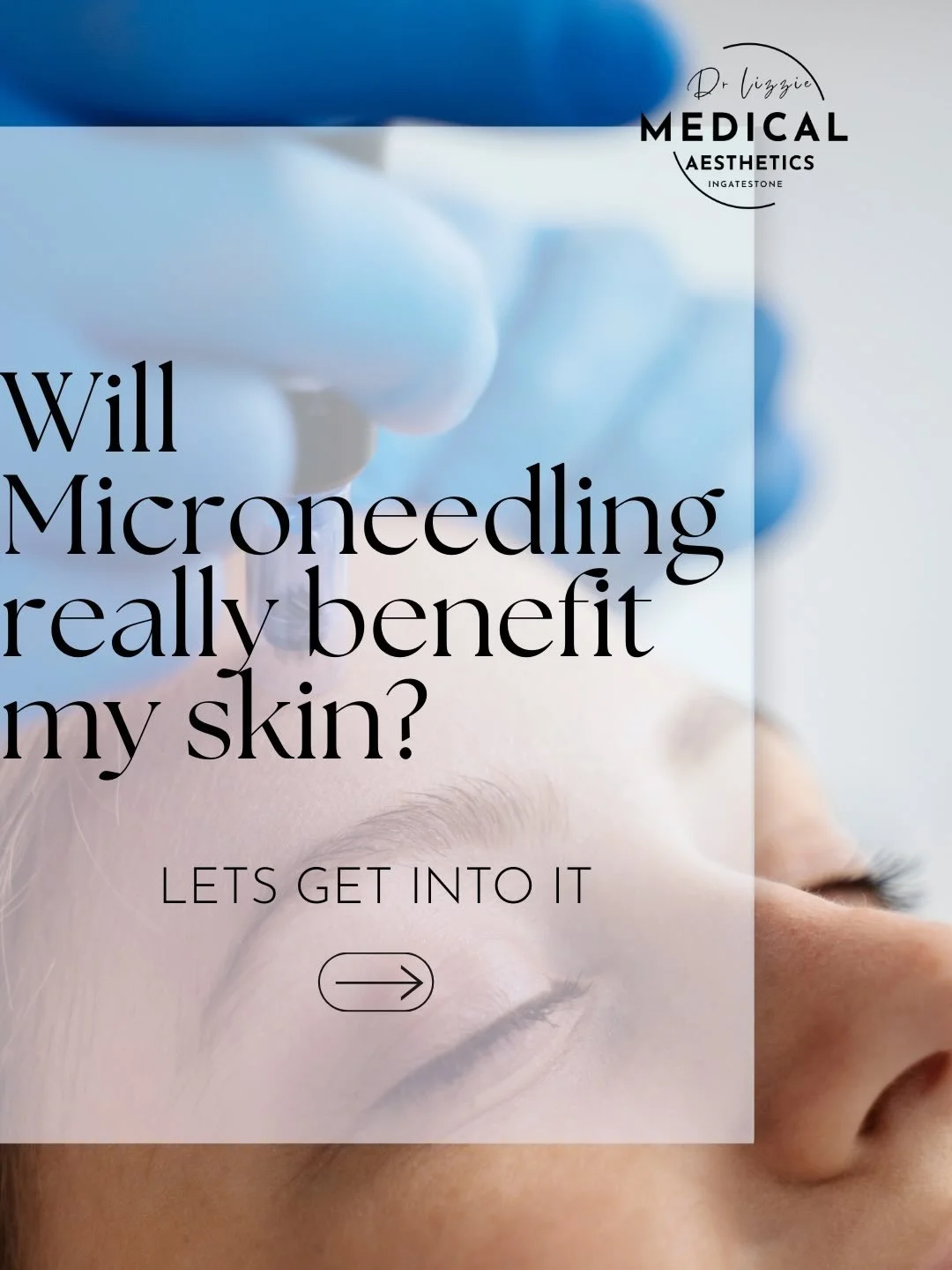 If it&rsquo;s great skin health you want and a renewed glow, microneedling is the way to go.
This treatment helps to smooth texture, reduce fine lines, improve tone, and boost collagen for long-lasting results. When you come into clinic, you can expe