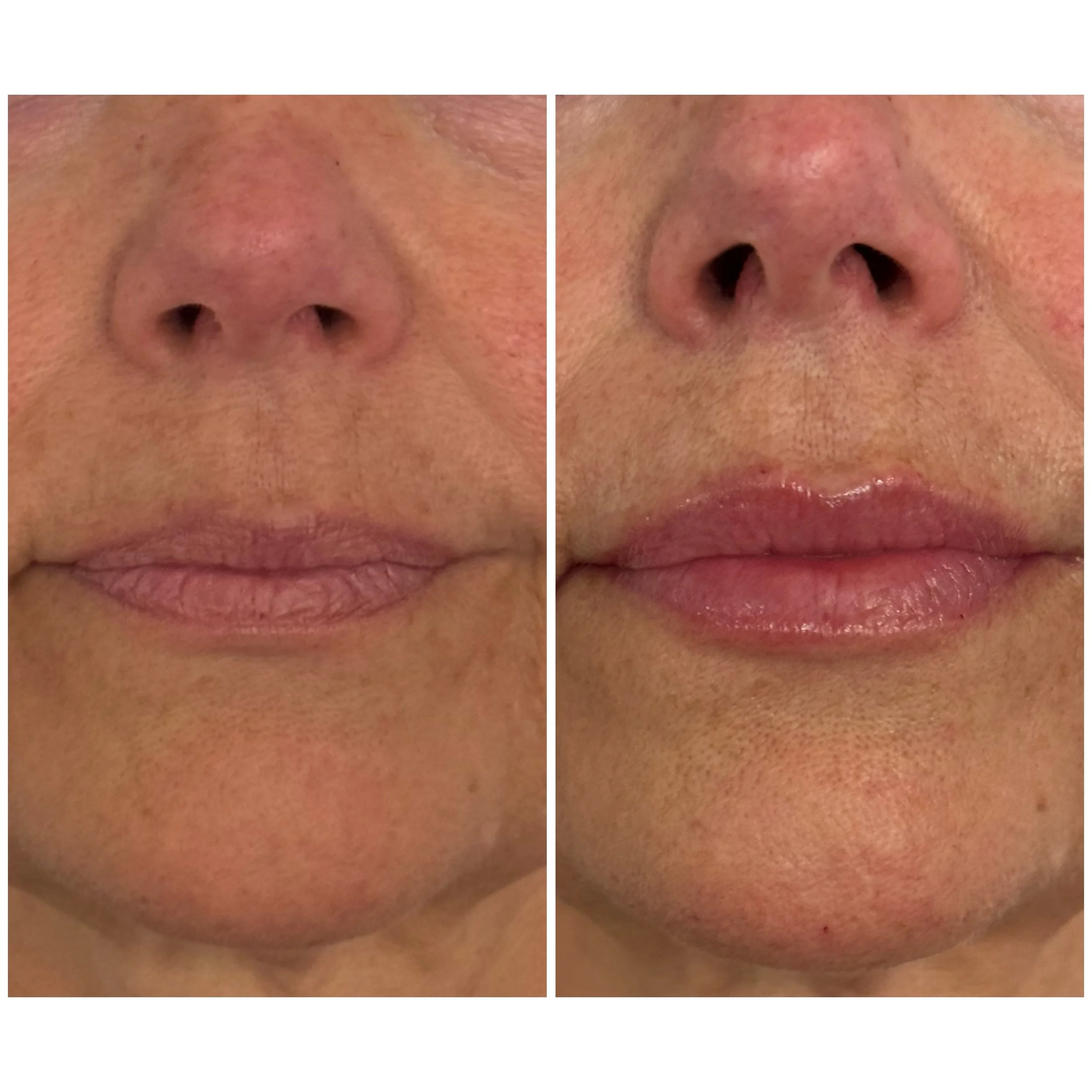Natural but noticeable and all under ultrasound imaging guidance. 

Lip filler gets a bad name as we see it done badly so often, but done well it&rsquo;s one of my favourite treatments to do in clinic. 

I do filler a little differently and ultrasoun