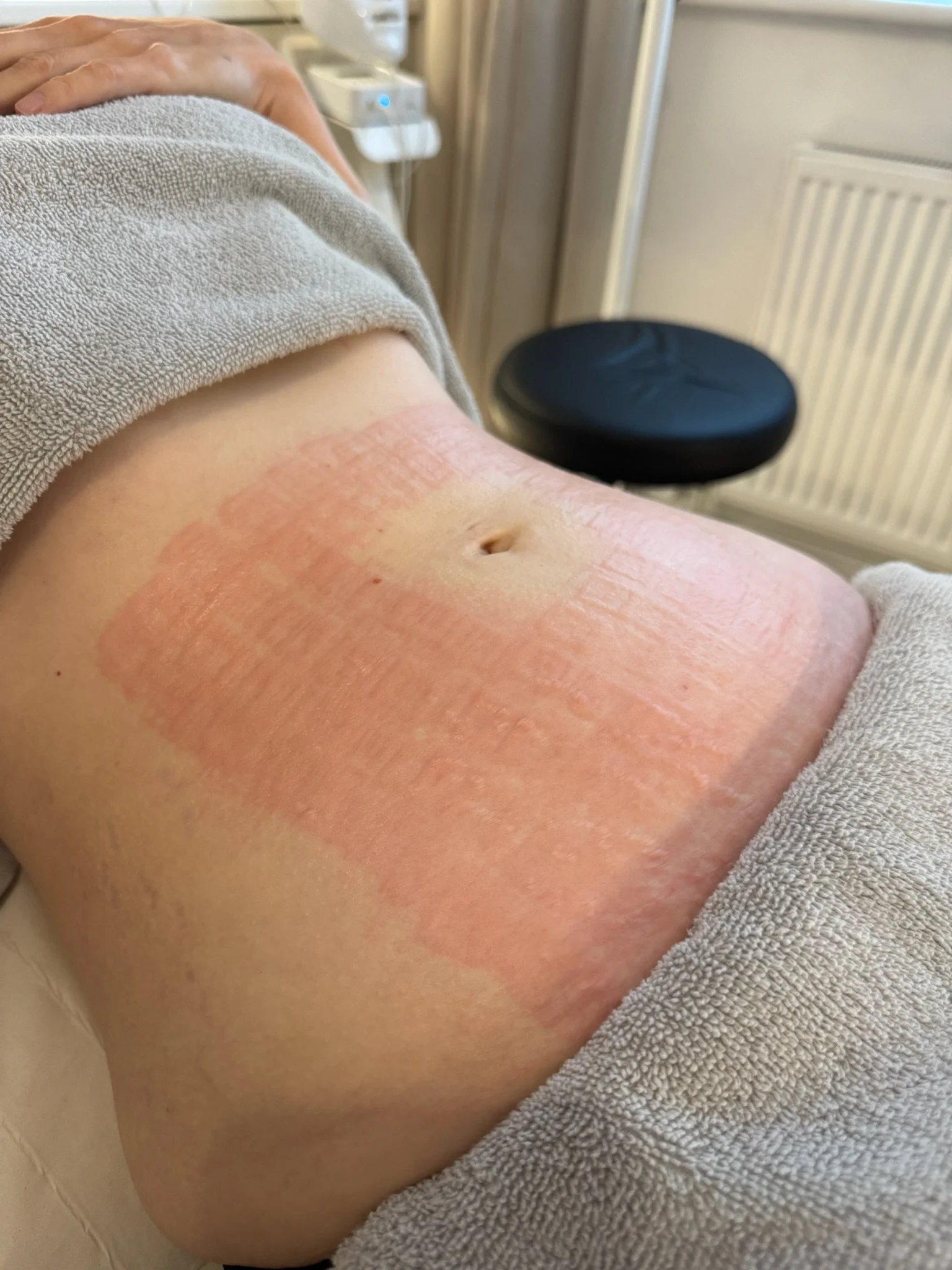 Abdomen after a RF microneedling treatment 
