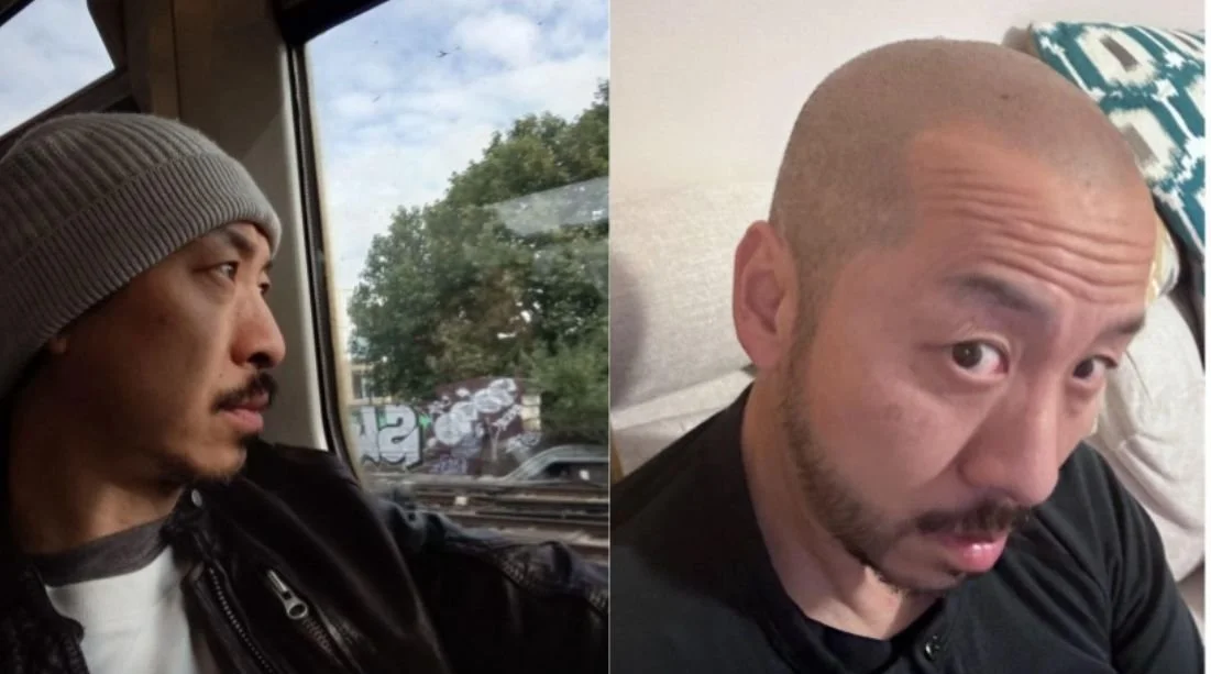 Be Comfortable in Your Own Skin: Embracing Hair Loss