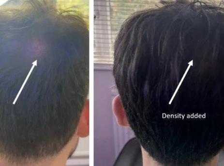 Transformative Hair Loss Solution