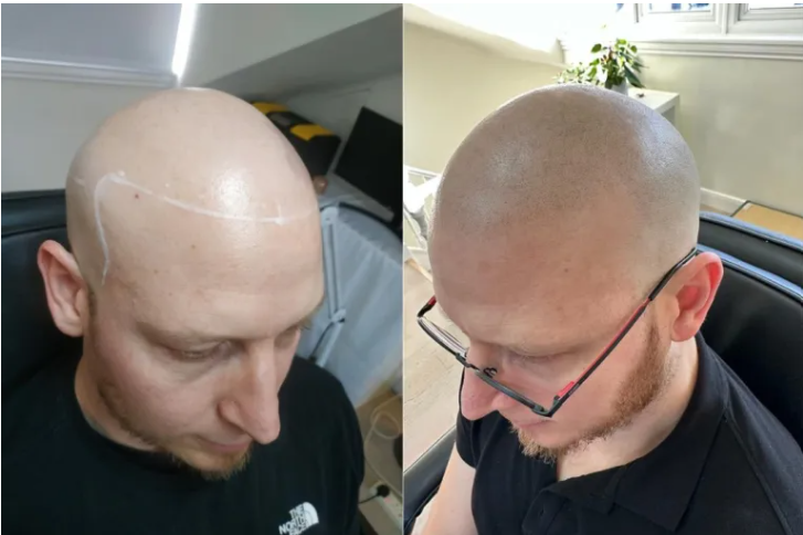Side-by-side comparison of a man before and after getting a bald head shave, showing the transformation from a partially shaved head with visible scars to a fully shaved, smooth scalp.