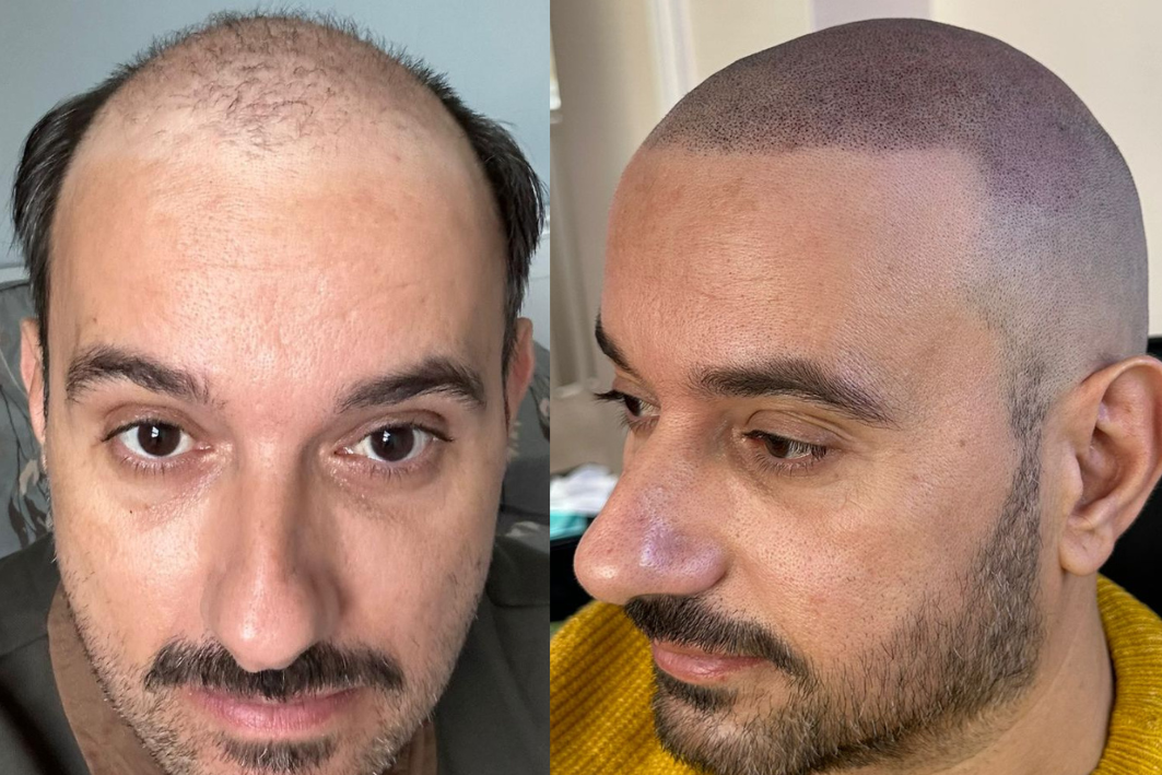 Side-by-side comparison of a man's head before and after a hair restoration or hair transplant. The left image shows a receding hairline with thinning hair, while the right image shows a full, shaved head with new hair growth.